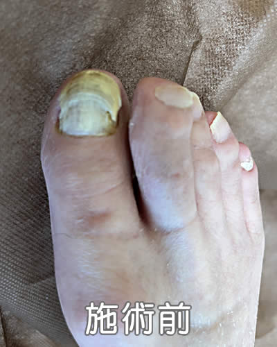 肥厚爪、爪白癬（81歳 男性 長期間の寝たきり）施術前