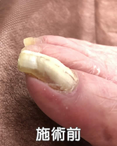 爪の表面の爪白癬 施術前