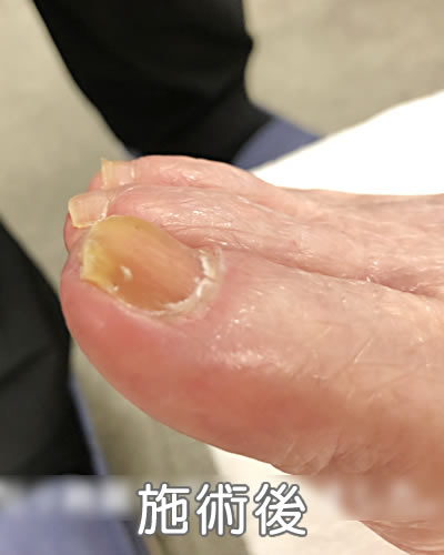 爪の表面の爪白癬 施術後