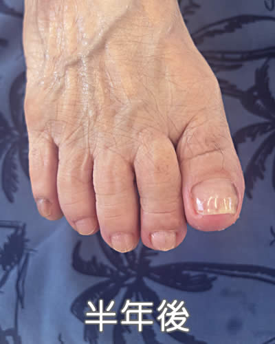 巻き爪矯正（93歳 女性 独居）半年後１