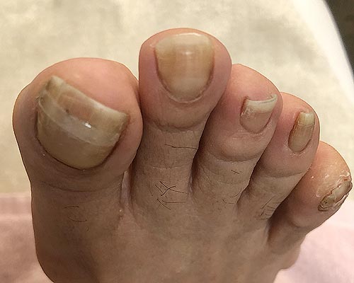 巻き爪BSテープ矯正4