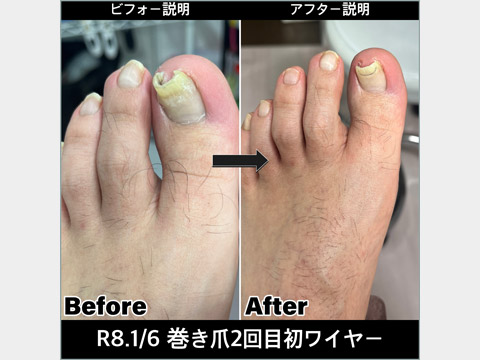 天使のつめきり相模原 巻き爪矯正 ビフォー・アフター